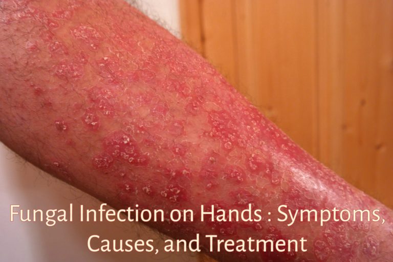 Fungal Infection On Hands Symptoms Causes And Treatment Candida